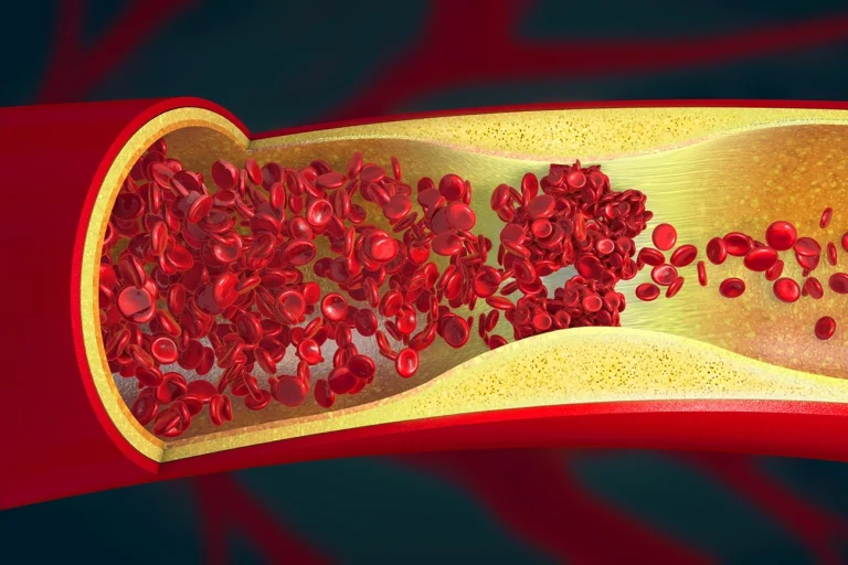 Cardiologista aponta os 2 piores hábitos que “entopem” as artérias